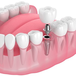 Illustration of a single dental implant