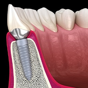 A CGI of dental implant osseointegration