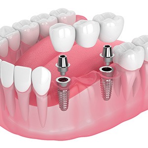 Illustration of an implant bridge