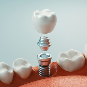 A CGI of dental implant parts