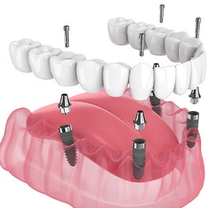 Illustration of an implant denture