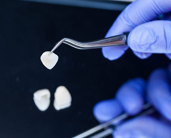 Gloved hand grasping veneers with dental instrument