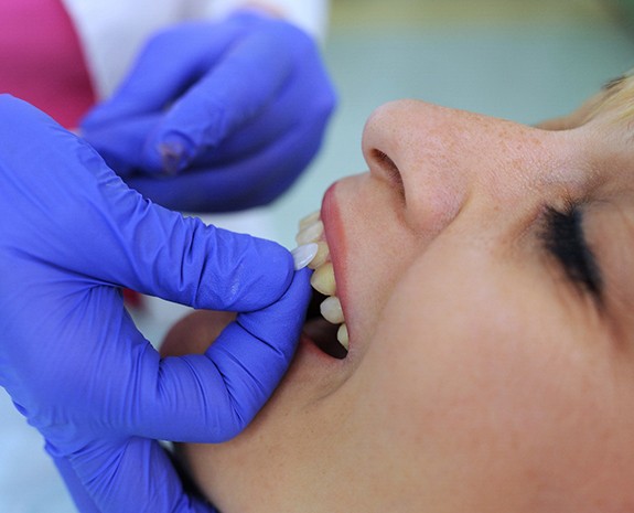 Gloved hands placing veneers over woman’s stained teeth